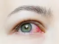 Occhio rosso e irritato, con evidente infiammazione. Possibili sintomi di infezione oculare.