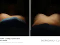 Lipotransfer biustu: porównanie efektów przed i po zabiegu. Widoczne piersi z zaznaczonymi punktami.