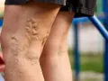 Nahaufnahme von Beinen mit sichtbaren, netzartigen Krampfadern. So sehen warnvenen aus, die sich unter der Haut abzeichnen.