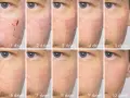 Post-laserowa regeneracja skóry: od 1. do 10. dnia widać, jak długo utrzymuje się opuchlizna i zaczerwienienie, aż do pełnego wygojenia.