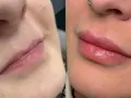 Powiększanie ust: Kwas hialuronowy, lip lift czy domowe triki?