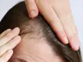 Manos tocando el cuero cabelludo, mostrando finos cabellos y piel. Podría indicar dolor cuero cabelludo o preocupación por la pérdida de cabello.