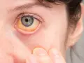 Jadłowstręt psychiczny objawy: jak rozpoznać niebezpieczne symptomy