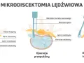 Ilustracja pokazuje mikrodiscektomię lędźwiową: przepuklinę, operację i usunięcie fragmentu krążka. Pamiętaj, czego nie wolno robić po operacji kręgosłupa lędźwiowego.