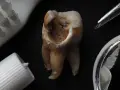 Zepsuty ząb, szczoteczka, pasta i pęseta. Czy próchnica jest zaraźliwa?