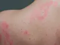 Widoczne różowe plamy na skórze, przypominające pokrzywkę, rozprzestrzeniają się na ramieniu i plecach.