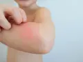 Kind kratzt sich am roten, geschwollenen Arm. Tipps, wie man Schnakenstiche behandeln kann, sind hier wichtig.