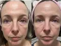 Confronto viso: pelle con niacinamide prima e dopo. Miglioramento di rossori e texture.