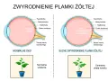 Porównanie zdrowego oka z suchym zwyrodnieniem plamki żółtej. Pokazuje, jak szybko powiększa się otwór plamki żółtej, prowadząc do utraty wzroku.