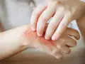 Juckende Haut: Ein Ekzem an der Hand, das durch Kratzen verschlimmert wird.