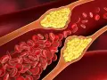 Die besten Medikamente bei Arteriosklerose: Wirkung und Kombinationen