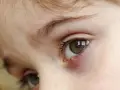 Occhio di bambino con un orzaiolo, segno di stress o stanchezza.