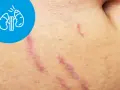 Rozstępy na skórze, które mogą być objawem choroby Cushinga. W lewym górnym rogu ikona nerek.