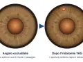 Iridotomia YAG: prima occlusione dell'angolo, dopo apertura per riaprire il deflusso. Valutare i rischi.