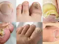 Gros plans de plusieurs orteils montrant différents stades de mycose de l'ongle, avec des ongles jaunis, épaissis et déformés.