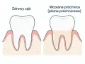 Zdrowy ząb obok zęba z wczesną próchnicą, czyli plamą próchnicową. Dentysta widzi różnicę w kolorze i strukturze szkliwa.
