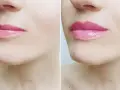 Przed i po zabiegu botox lip flip. Usta po zabiegu są pełniejsze i bardziej wyraziste.