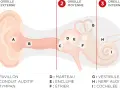 Schéma de l'oreille montrant les différentes parties. La cochlée (I) contient les cellules ciliées endommagées, essentielles à l'audition.