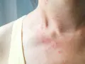 Czerwona, swędząca wysypka na szyi i klatce piersiowej, objaw uczulenia na białko u dorosłych.