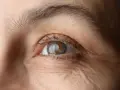 Occhio con rughe evidenti e iride bicolore. Possibili sintomi di alterazione film lacrimale.