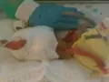 Maleńki noworodek, dziecko urodzone w 25 tygodniu ciąży, w inkubatorze, otoczony opieką medyczną.