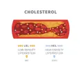 Niski cholesterol LDL sprzyja miażdżycy, tworząc złogi w naczyniach. Wysoki HDL chroni.