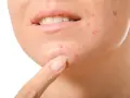 Primo piano del viso di una persona con evidenti segni di acne cistica sul mento e sulla guancia, con un dito che indica una lesione.