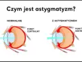 Astygmatyzm: Rozpoznaj i odzyskaj ostre widzenie!