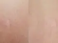 Jasna skóra z widocznymi, lekko zaróżowionymi bliznami po depilacji laserowej.