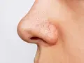 Gros plan sur un nez avec de nombreux points noirs visibles.