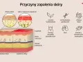 Ilustracja porównująca zdrową skórę i skórę z zapaleniem, z ikonami przedstawiającymi przyczyny AZS.