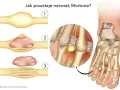 Ilustracja pokazuje powstawanie nerwiaka Mortona, który może powodować zapalenie śródstopia. Objawy to ucisk na nerw.