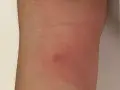 Piel enrojecida con una pequeña protuberancia, indicativa de picaduras chinches de cama como eliminarlas.
