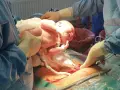 Noworodek wychodzi z brzucha mamy, ręce lekarzy pomagają w porodzie, który był w położeniu miednicowym.