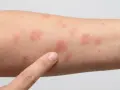 Nahaufnahme eines Arms mit mehreren roten Stellen auf der Haut, die auf einen Ausschlag oder eine allergische Reaktion hindeuten.