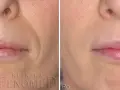 1 ml kwasu hialuronowego: Co naprawdę zmieni w Twojej twarzy?