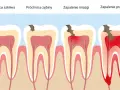 Co wziąć na ból zęba? Skuteczne leki i domowe sposoby na ulgę