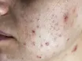 Primo piano della pelle con acne, inclusi diversi brufoli cistici e rossori.