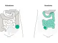 Vergleich von Kolostoma und Ileostoma: zwei stoma arten, die den Darm betreffen.
