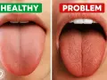 Zdrowy język vs. język z kserostomią. Porównanie objawów i wskazówki dotyczące leczenia.