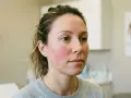 Femme avec rougeurs sur les joues, signe d'une barrière cutanée fragilisée.