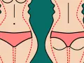 Ilustracja pokazuje sylwetkę przed i po zabiegu liposukcji ud. Czerwone linie zaznaczają obszary do modelowania.