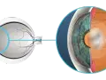 Sezione dell'occhio che mostra la lente e la retina. Si notano aloni dopo capsulotomia, un effetto visivo comune.