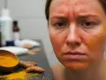 Visage marqué par des rougeurs et des boutons, avec des traces de cataplasme de curcuma. Des racines et de la poudre de curcuma sont visibles à côté.