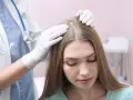Lekarz w białej rękawiczce bada skórę głowy pacjentki, która martwi się nadmiernym wypadaniem włosów.
