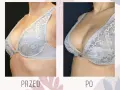 Ile kosztuje powiększenie biustu w Niemczech? Sprawdź, co wpływa na cenę