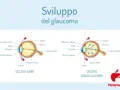 Confronto tra occhio sano e occhio con glaucoma, illustrando l'aumento di pressione. Il termine "abbigliamento significato" non si applica qui.