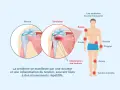Illustration montrant une tendinite à l'épaule, une inflammation des tendons. L'ibuprofène peut aider à soulager ces douleurs.