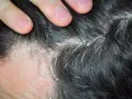 Dedos separando cabello oscuro con caspa blanca. ¿Cómo aliviar el picor de cabeza por estrés?