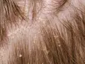 Nahaufnahme der Kopfhaut mit sichtbaren gelblichen Krusten und Schuppen, die sich zwischen den braunen Haaren abzeichnen.